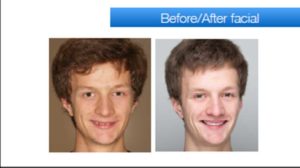 before-after-facial
