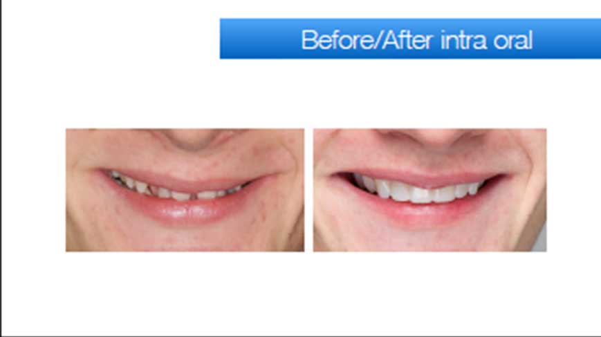 before-after-intra-oral