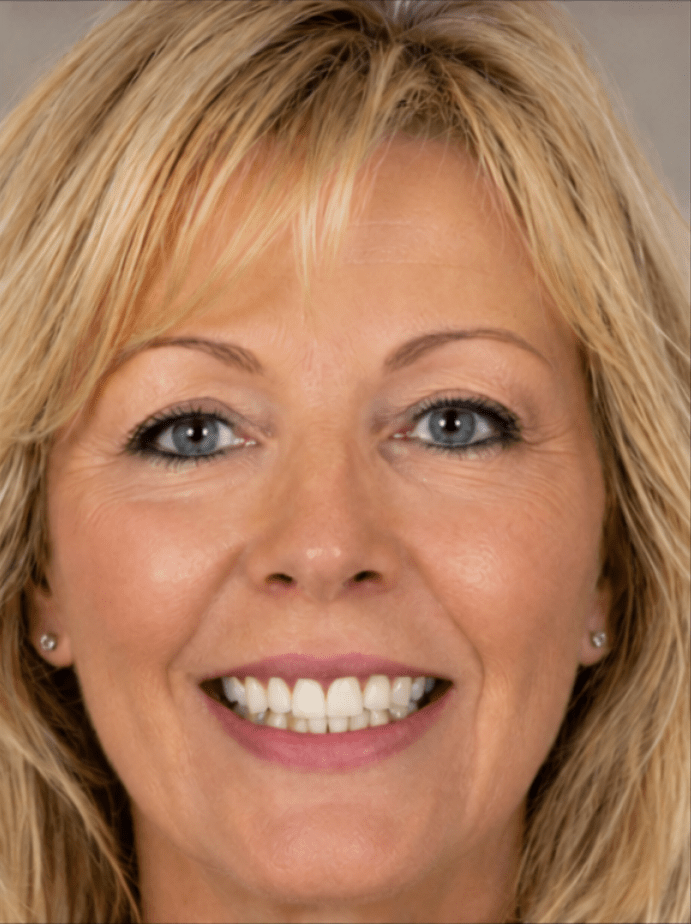 Same smile after DentalMagic AI whitening and alignment simulation